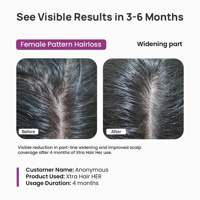 Before and after comparison of female pattern hairloss with Xtra Hair HER usage.