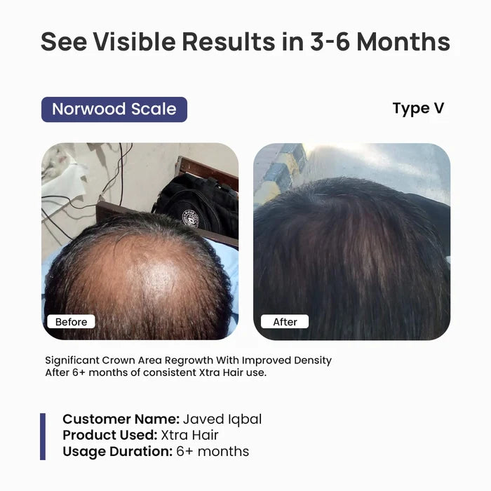 Before and after comparison of hair regrowth using Xtra Hair product, showing significant crown area regrowth.