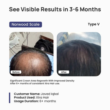 Before and after comparison of hair regrowth using Xtra Hair product, showing significant crown area regrowth.