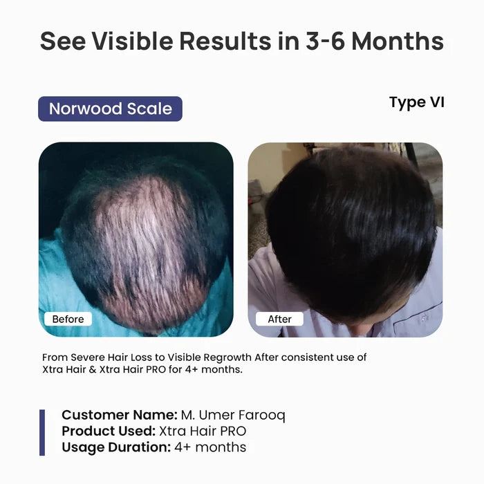 Before and after comparison of hair growth using Xtra Hair PRO, showing a Norwood Scale Type VI person with visible results in 3-6 months.