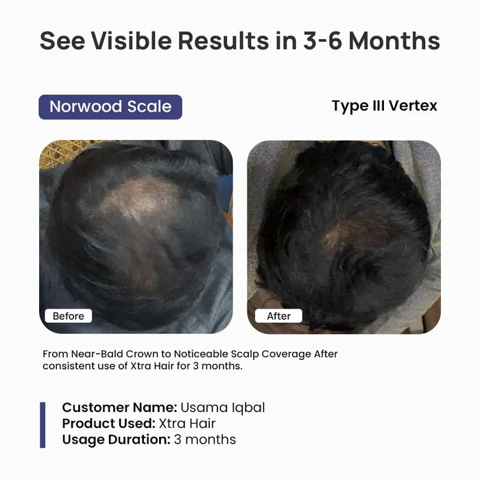 Before and after comparison of scalp coverage with Xtra Hair product, showing visible results in 3-6 months.