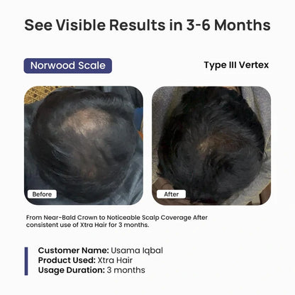 Before and after comparison of scalp coverage with Xtra Hair product, showing visible results in 3-6 months.