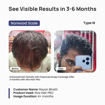 Before and after comparison of hair density using Xtra Hair PRO with Norwood Scale Type III, showing visible results in 3-6 months.
